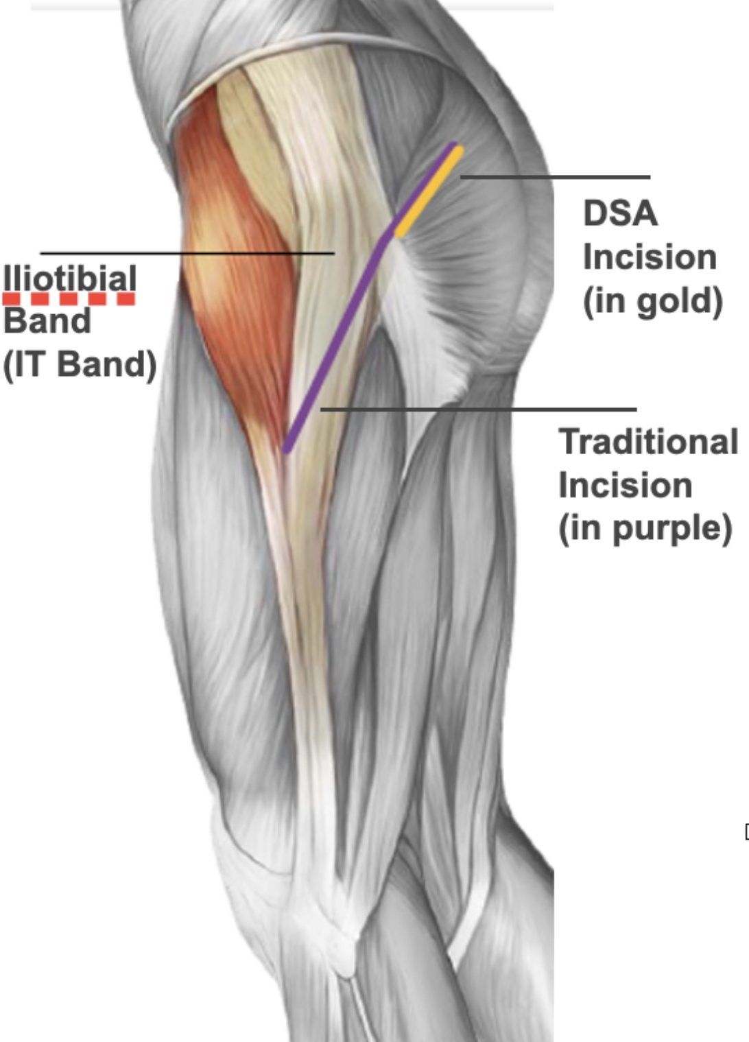 Anatomical diagram of the outer hip and thigh comparing the short direct superior (DSA) incision, shown in gold, with the longer traditional incision, shown in purple. The iliotibial band running down the outer thigh is left untouched by the DSA incision.