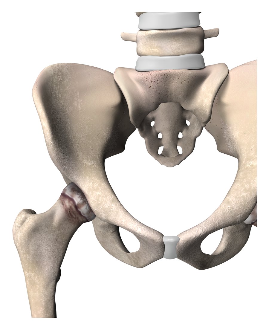 3D illustration of a pelvis with an arthritic hip joint, the cartilage worn away and the joint surfaces roughened