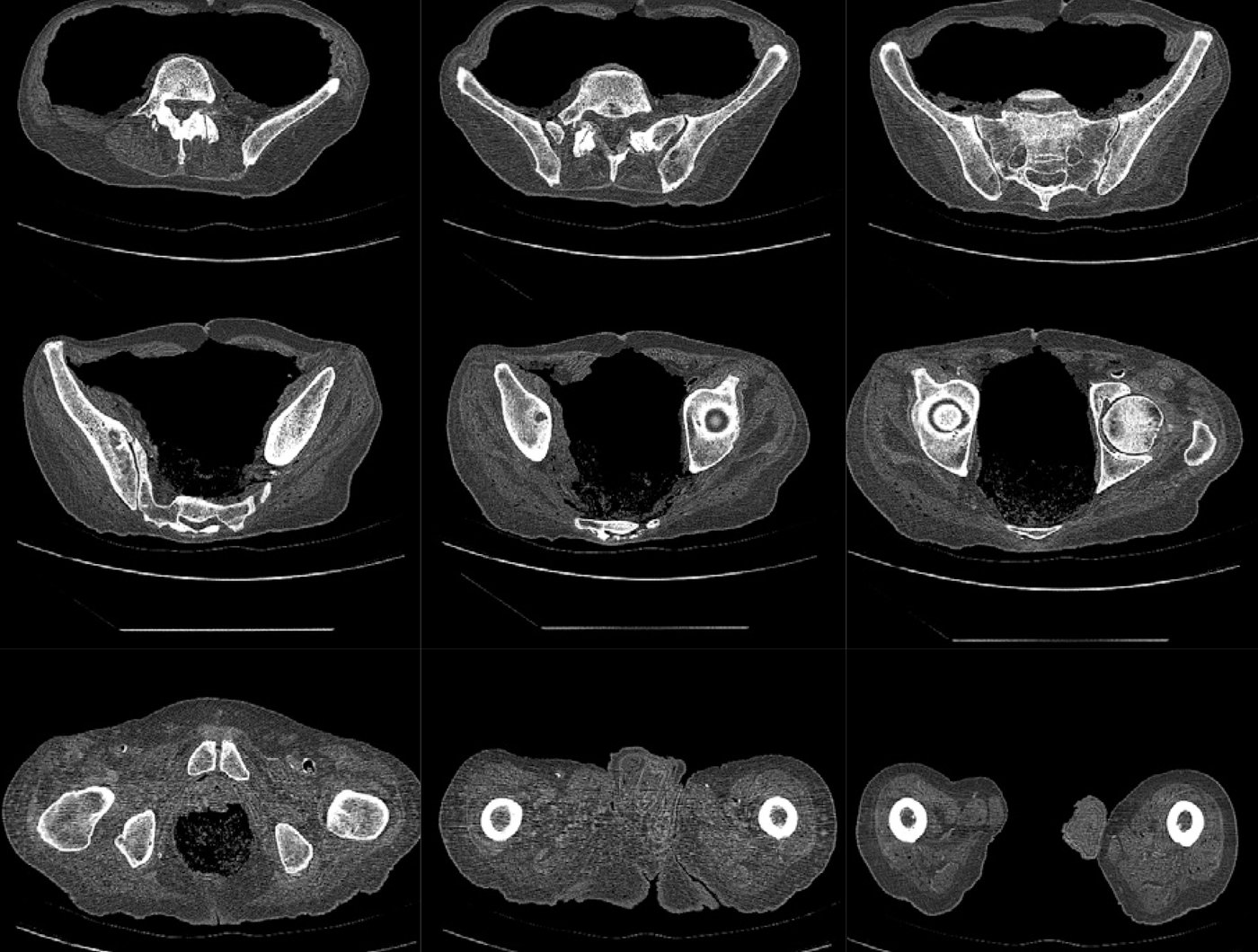 A grid of CT scan slices through the pelvis and hips used to build the 3D surgical plan.