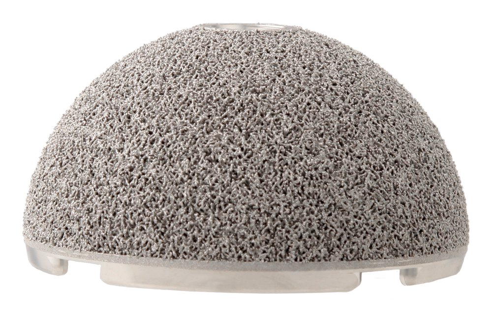 A hemispherical titanium acetabular cup implant with a porous ingrowth surface