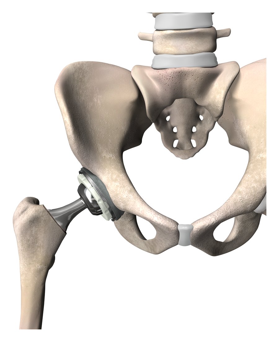 3D illustration of a pelvis after total hip replacement, with a new ball and socket implant in place