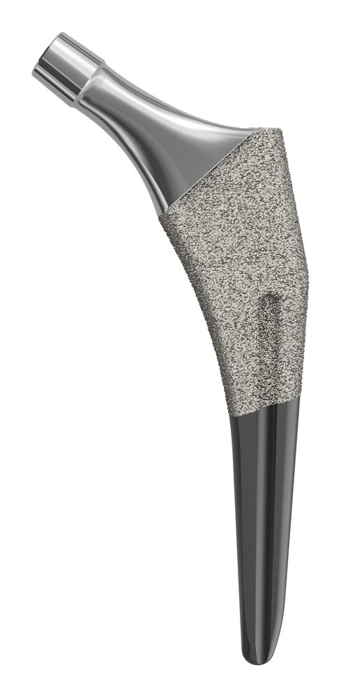 A titanium femoral stem hip implant with a porous coating on its upper portion