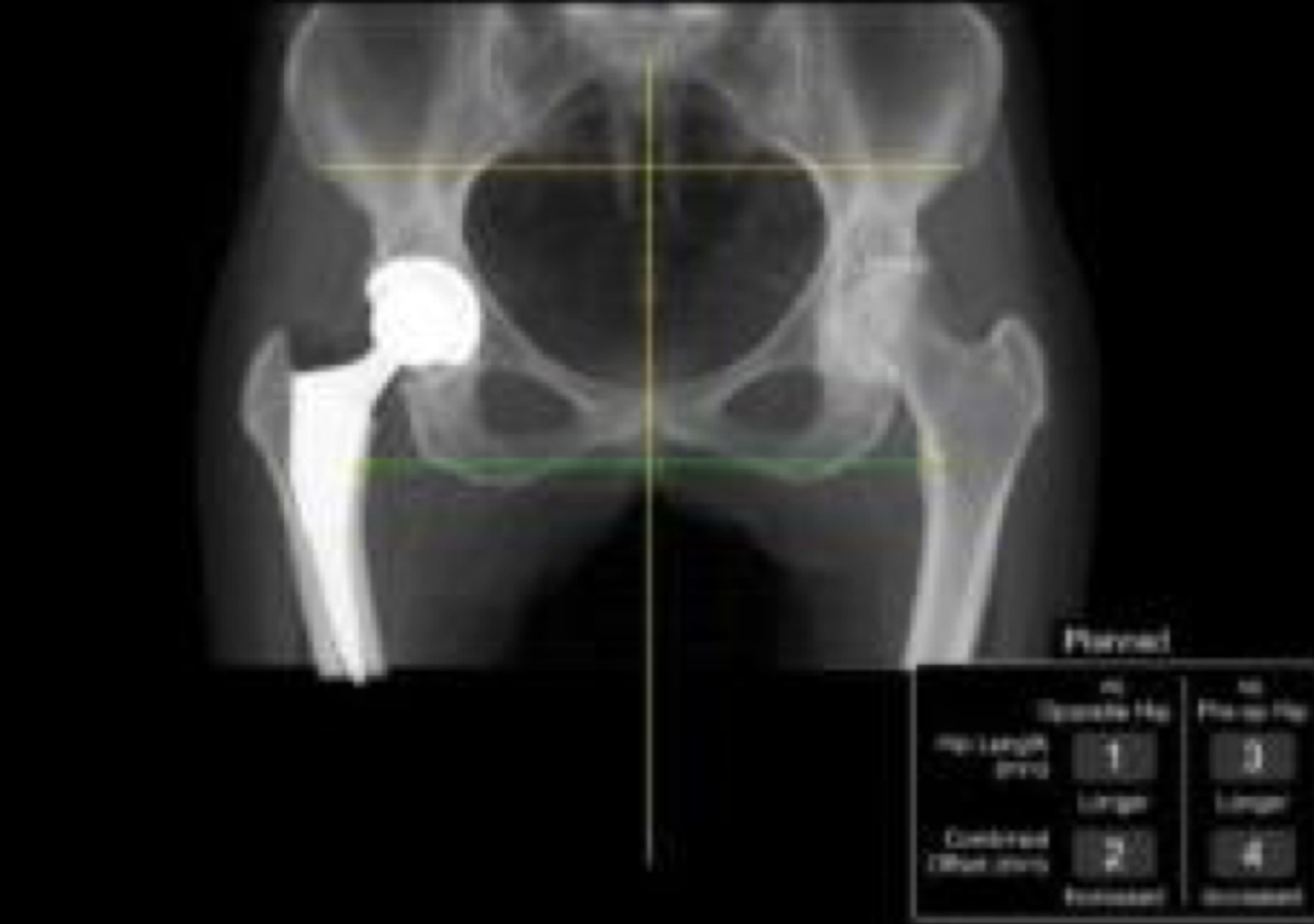 A hip X-ray overlaid with the Mako system's leg length and offset measurements comparing the new hip to the plan.