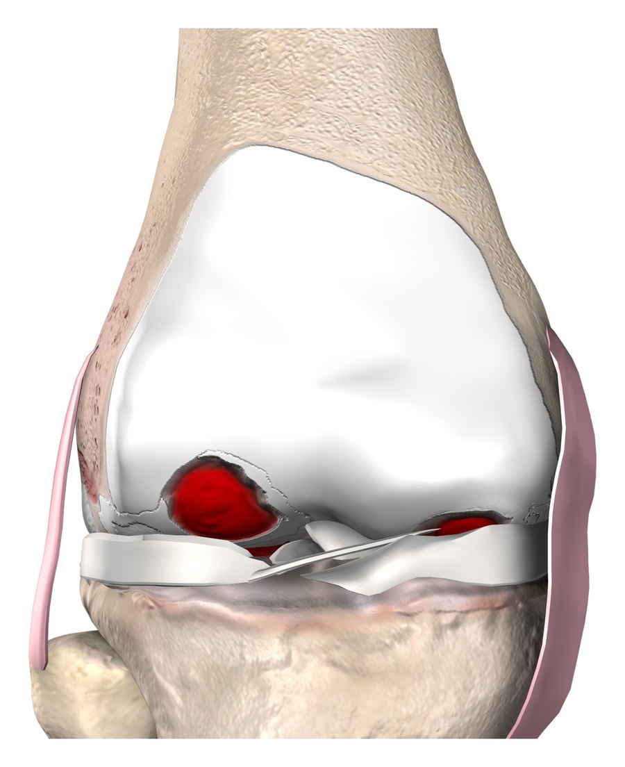 3D illustration of an arthritic knee joint with cartilage worn through to exposed bone