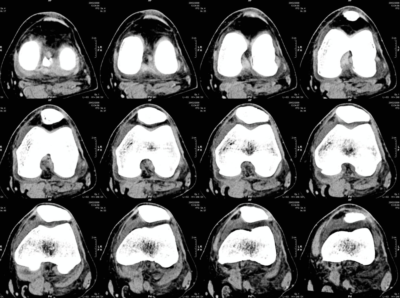 A grid of CT scan slices through the knee used to build the 3D model for robotic planning.