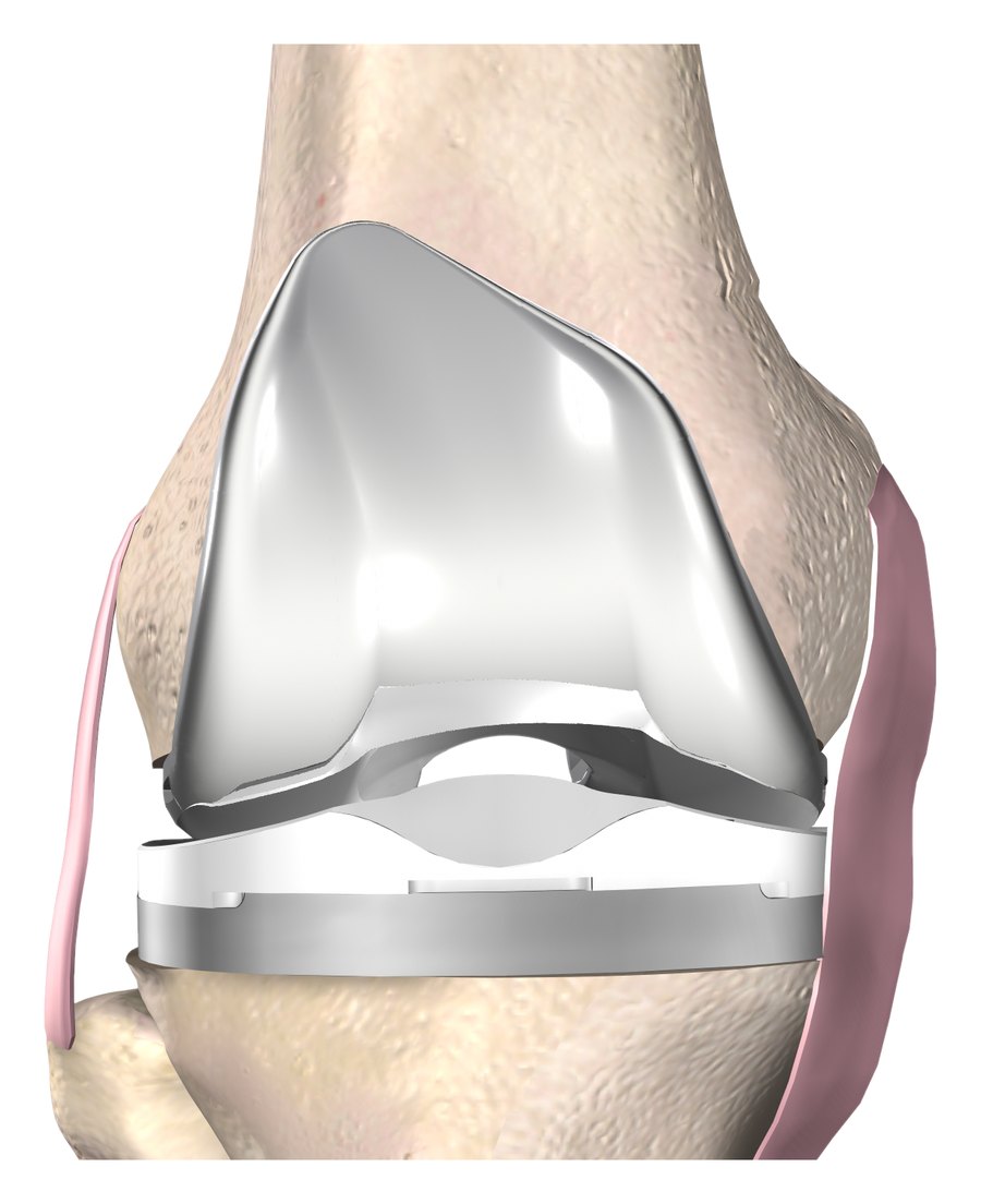 3D illustration of a knee after total knee replacement with the implant surfaces in place