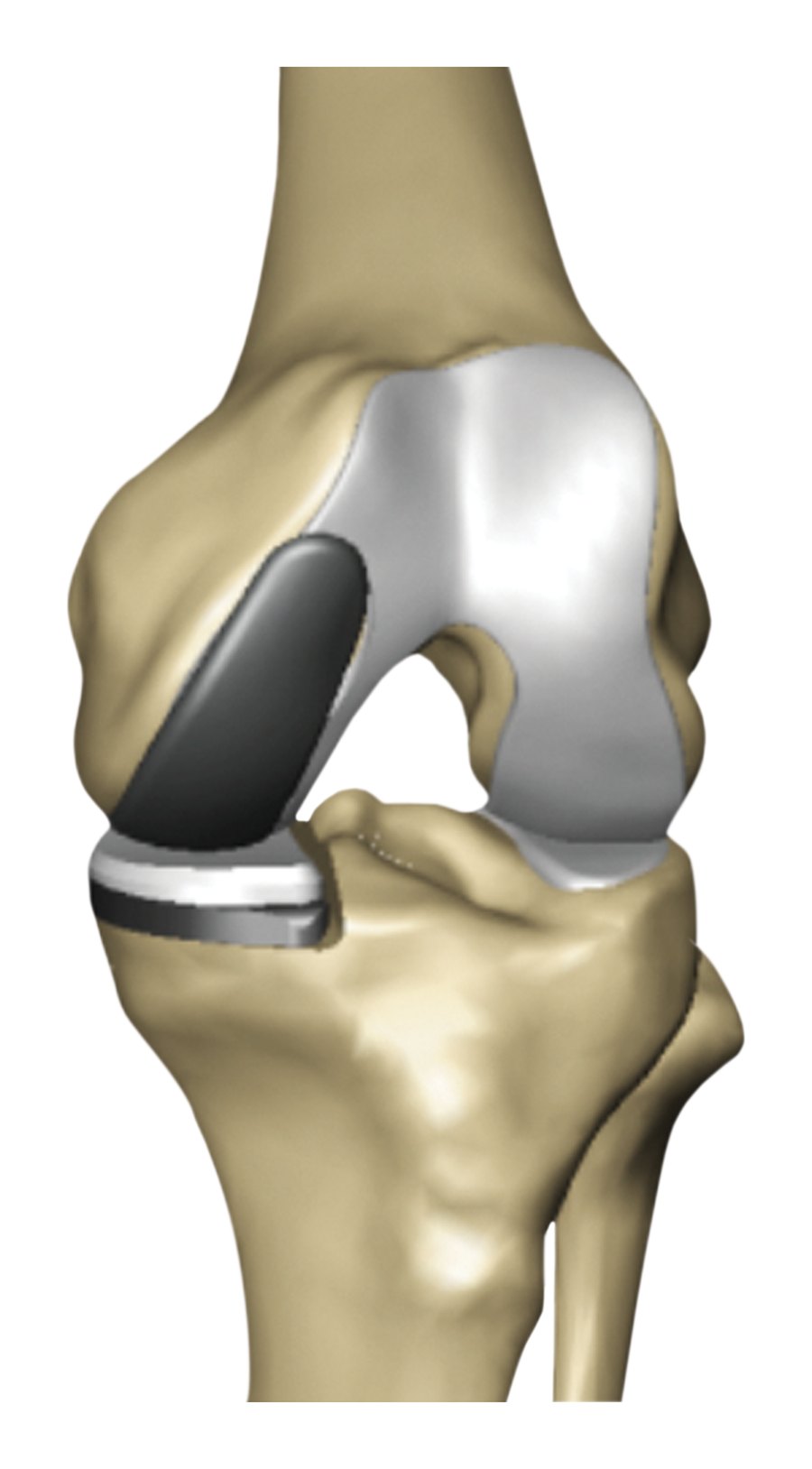3D illustration of a partial knee replacement resurfacing only the inner compartment of the knee