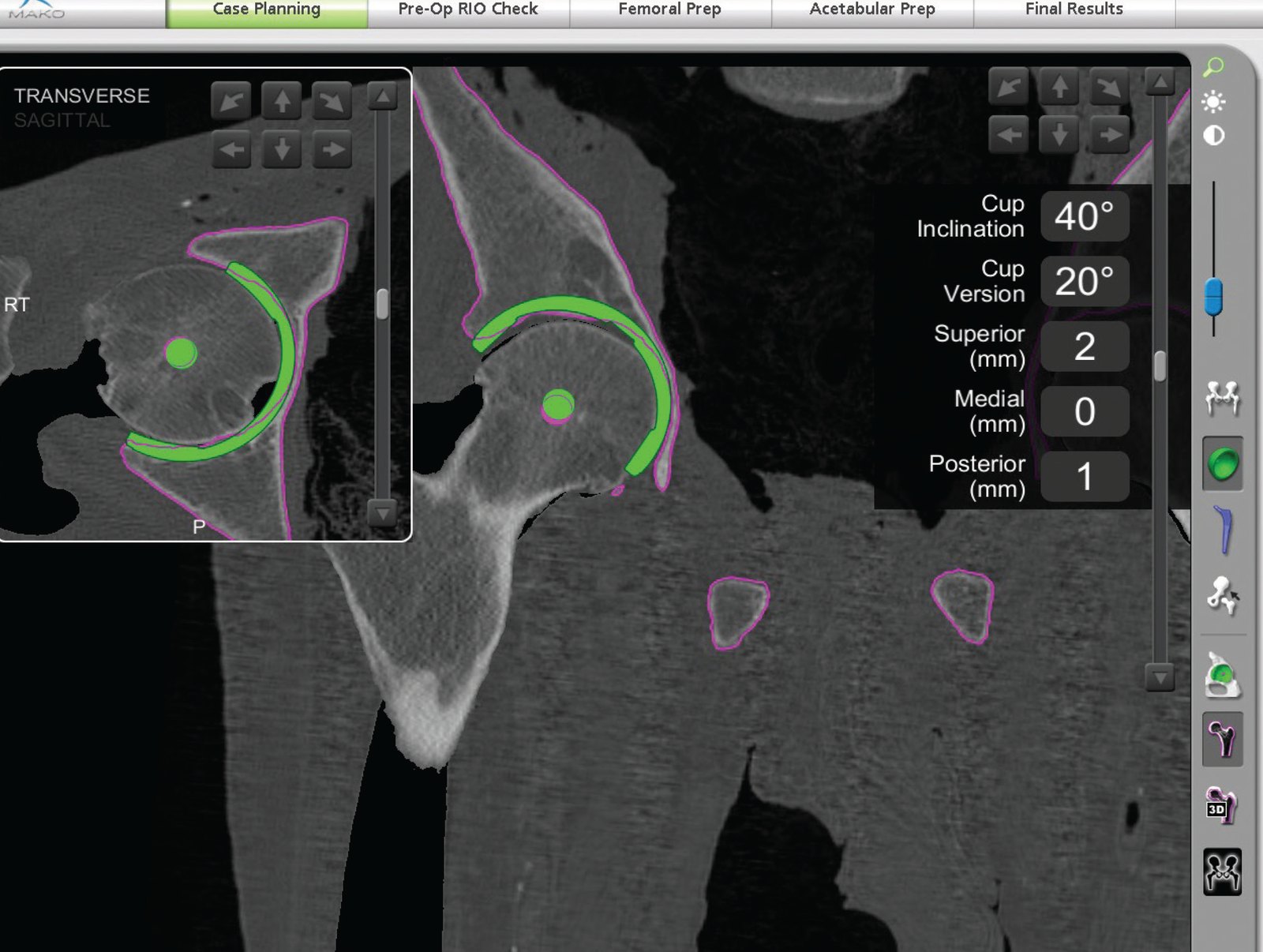The Mako hip planning software showing the planned cup position on a CT scan, with cup inclination of 40 degrees and version of 20 degrees displayed.