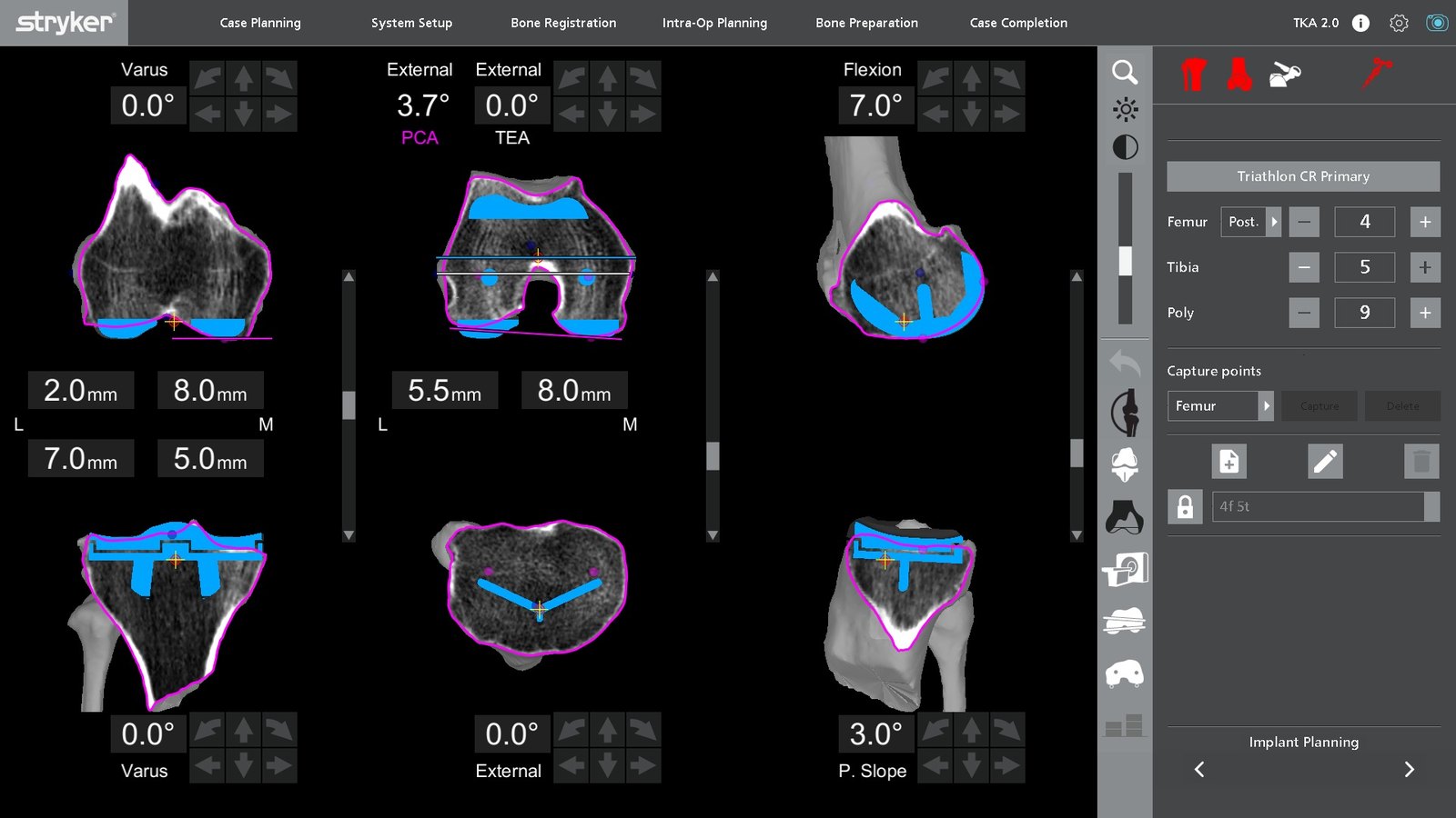 The Mako knee planning software showing implant position planned on the patient's CT scan with rotation, resection depths, and tibial slope displayed in degrees and millimeters.