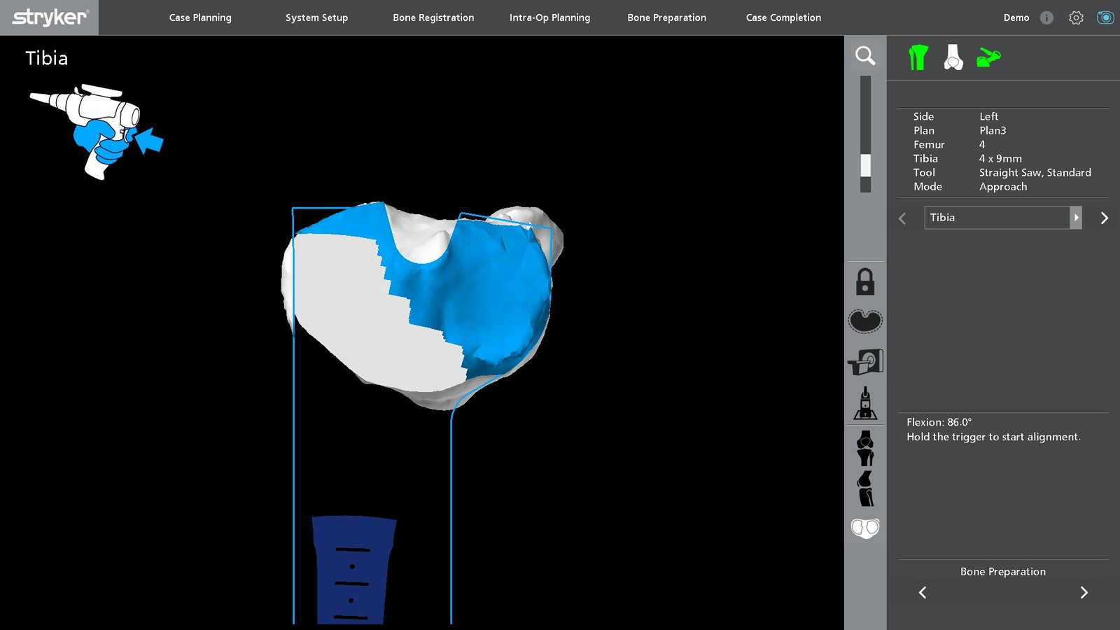 The Mako software during tibial bone preparation, showing the planned resurfacing region highlighted in blue on a 3D model of the tibia.