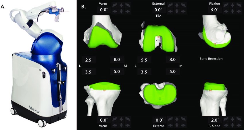 The Mako robotic arm beside its surgical planning software screens, which show a 3D CT model of the knee with the planned implant position overlaid in green and the planned angles and bone resection depths displayed in degrees and millimeters.