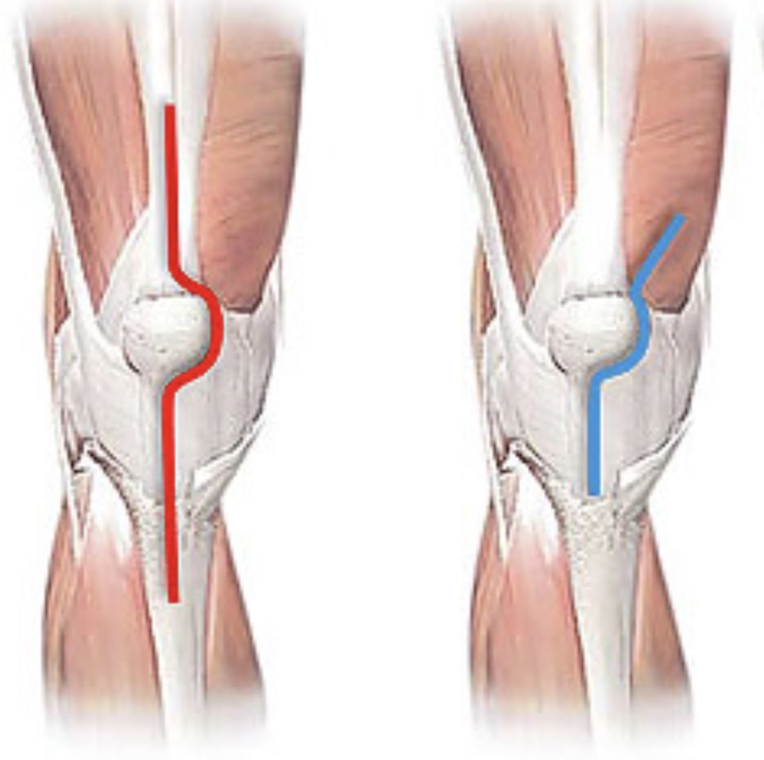 Side-by-side comparison of two knee diagrams. Left: a traditional medial parapatellar incision, drawn in red, extends up into the quadriceps tendon. Right: the midvastus incision, drawn in blue, is shorter and angles into the vastus medialis muscle, sparing the tendon.