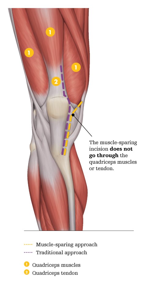 Full-leg anatomical illustration of the thigh muscles showing that the muscle-sparing incision path does not pass through the quadriceps muscles or tendon, compared with the traditional approach.