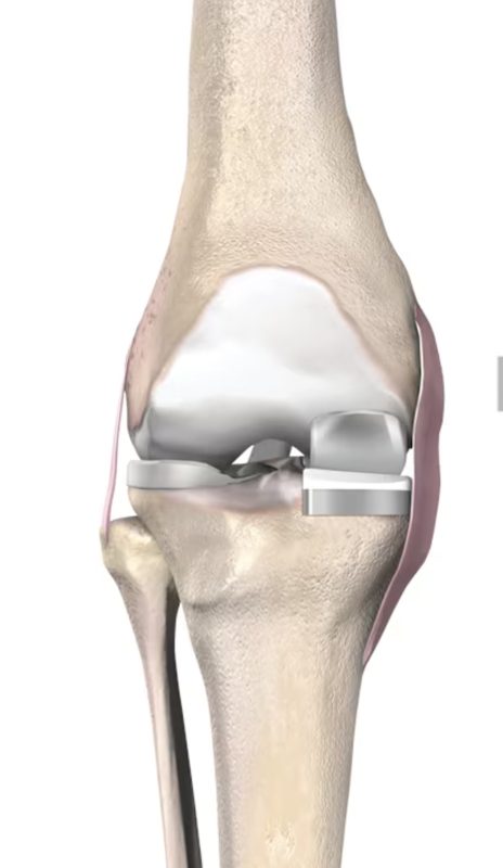 Partial knee replacement implant illustration
