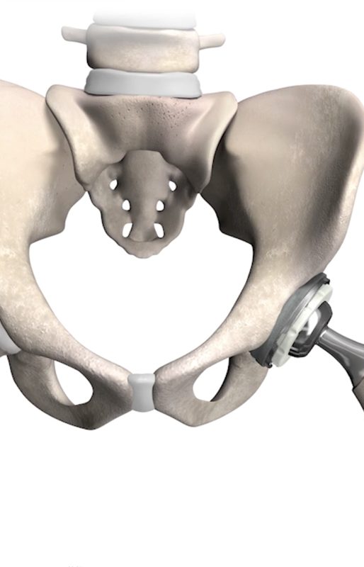 Total hip replacement implant illustration