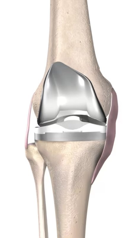 Total knee replacement implant illustration